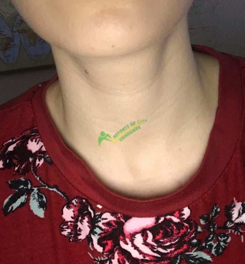 After 2.5 Weeks Of Use Of Strivectin Neck Cream