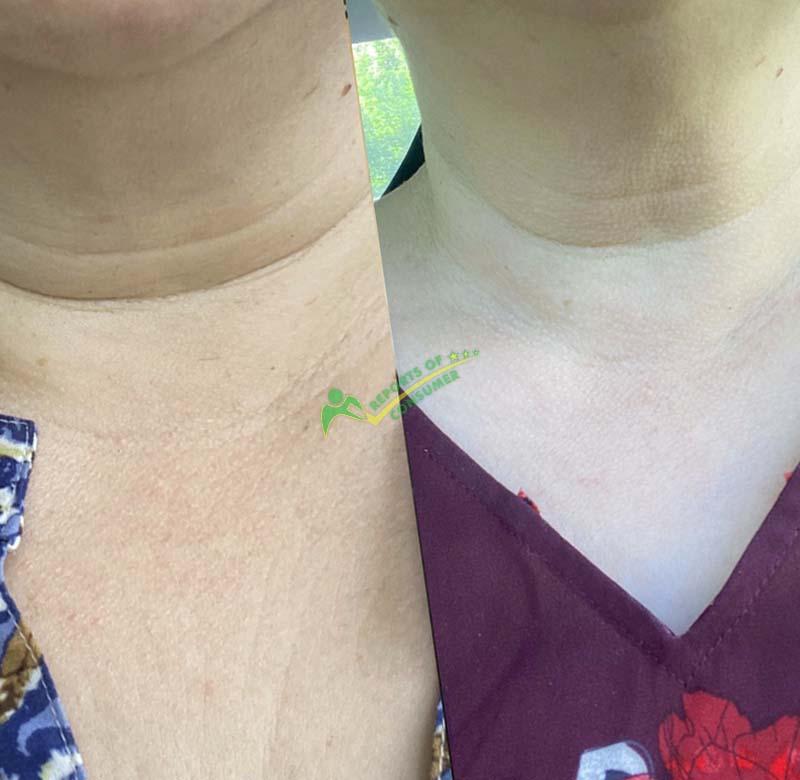 Consumer Report Before And After Using Strivectin Tl Advanced Tightening Neck Cream