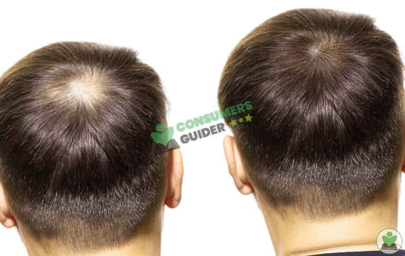 Before And After Laser Hair Growth Review